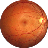 cirurgia de retina