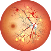 retinopatia
