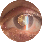 cirurgia de vitreo